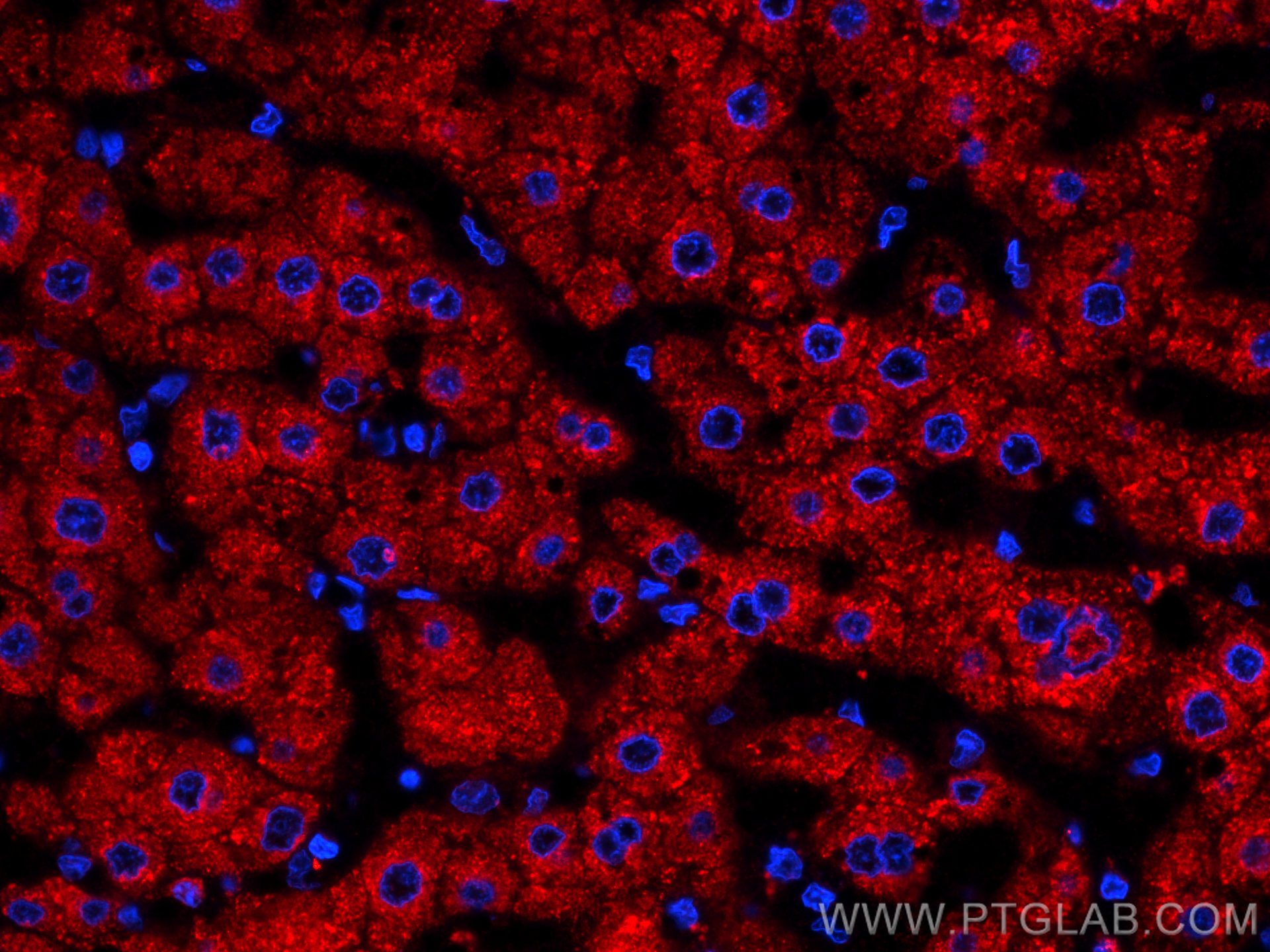 Immunofluorescence (IF) / fluorescent staining of human liver cancer tissue using CoraLite®594-conjugated Plasminogen Monoclonal ant (CL594-66399)