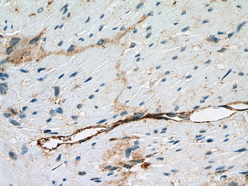 Immunohistochemistry (IHC) staining of human appendicitis tissue using Podoplanin Monoclonal antibody (67432-1-Ig)