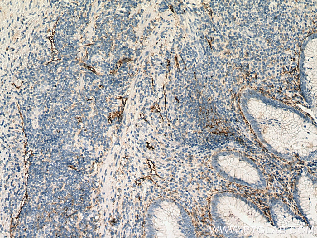 Immunohistochemistry (IHC) staining of human appendicitis tissue using Podoplanin Monoclonal antibody (67432-1-Ig)