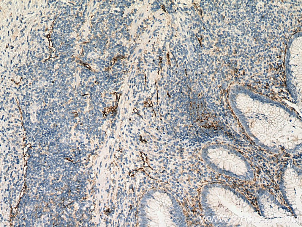 IHC staining of human appendicitis using 67432-1-Ig