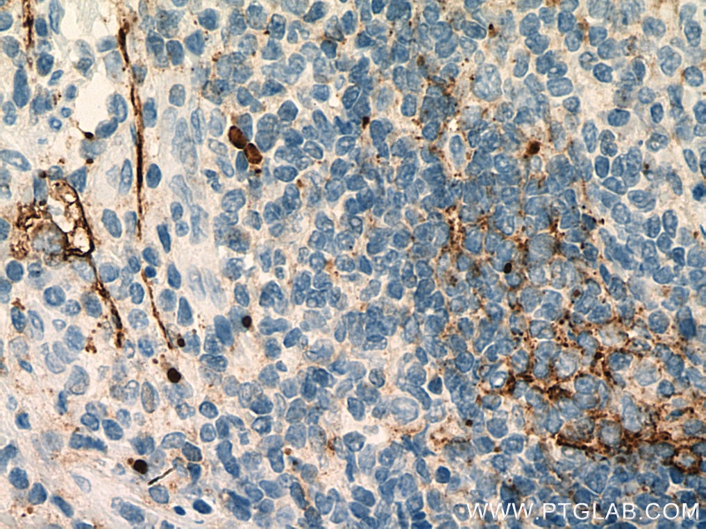 Immunohistochemistry (IHC) staining of human appendicitis tissue using Podoplanin Monoclonal antibody (67432-1-Ig)