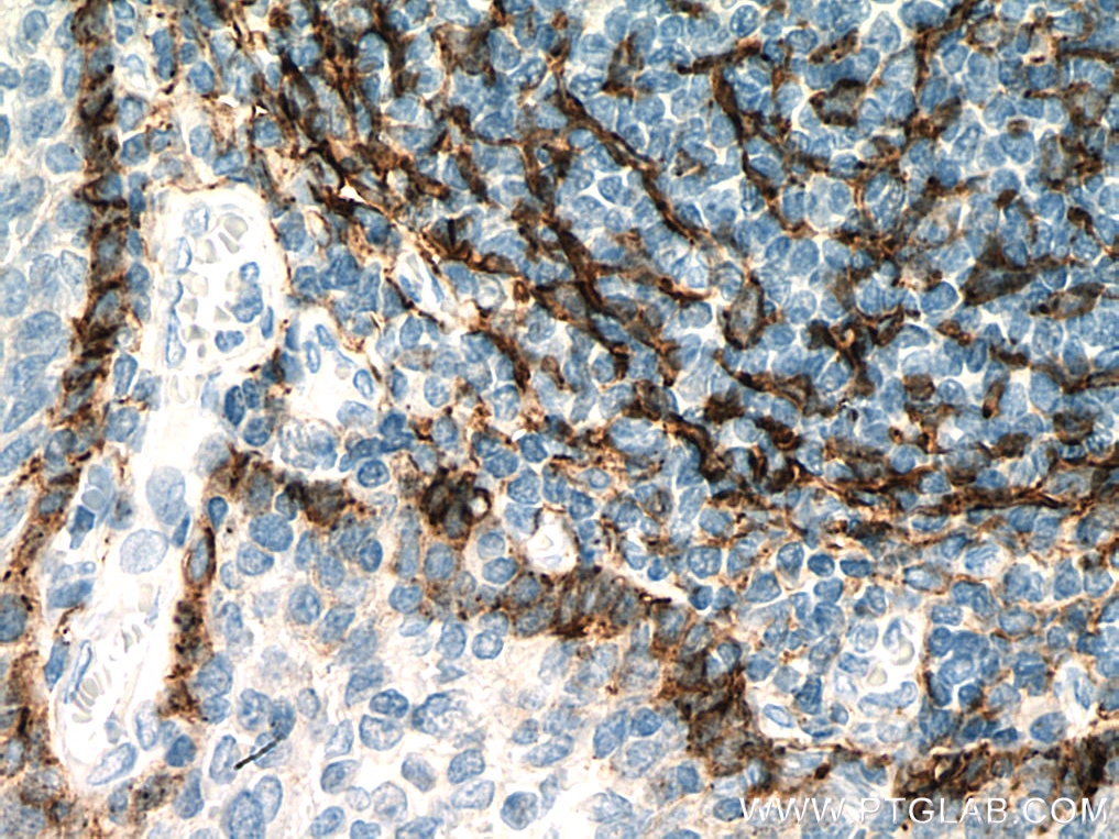 Immunohistochemistry (IHC) staining of human tonsillitis tissue using Podoplanin Monoclonal antibody (67432-1-Ig)
