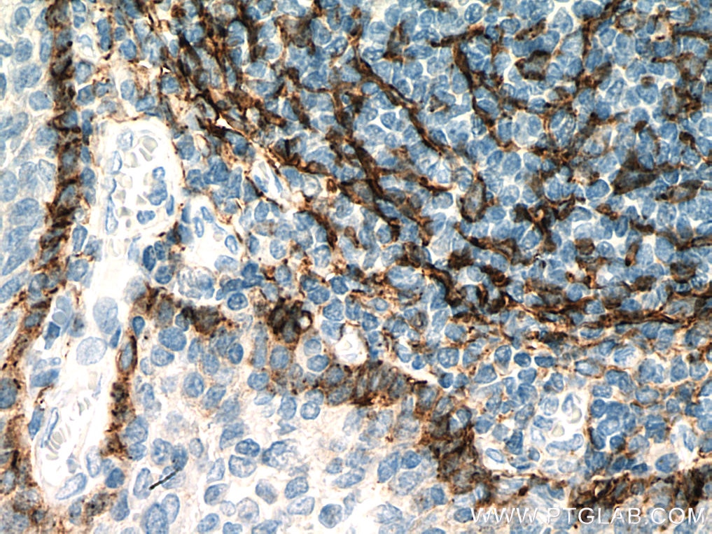 IHC staining of human tonsillitis using 67432-1-Ig