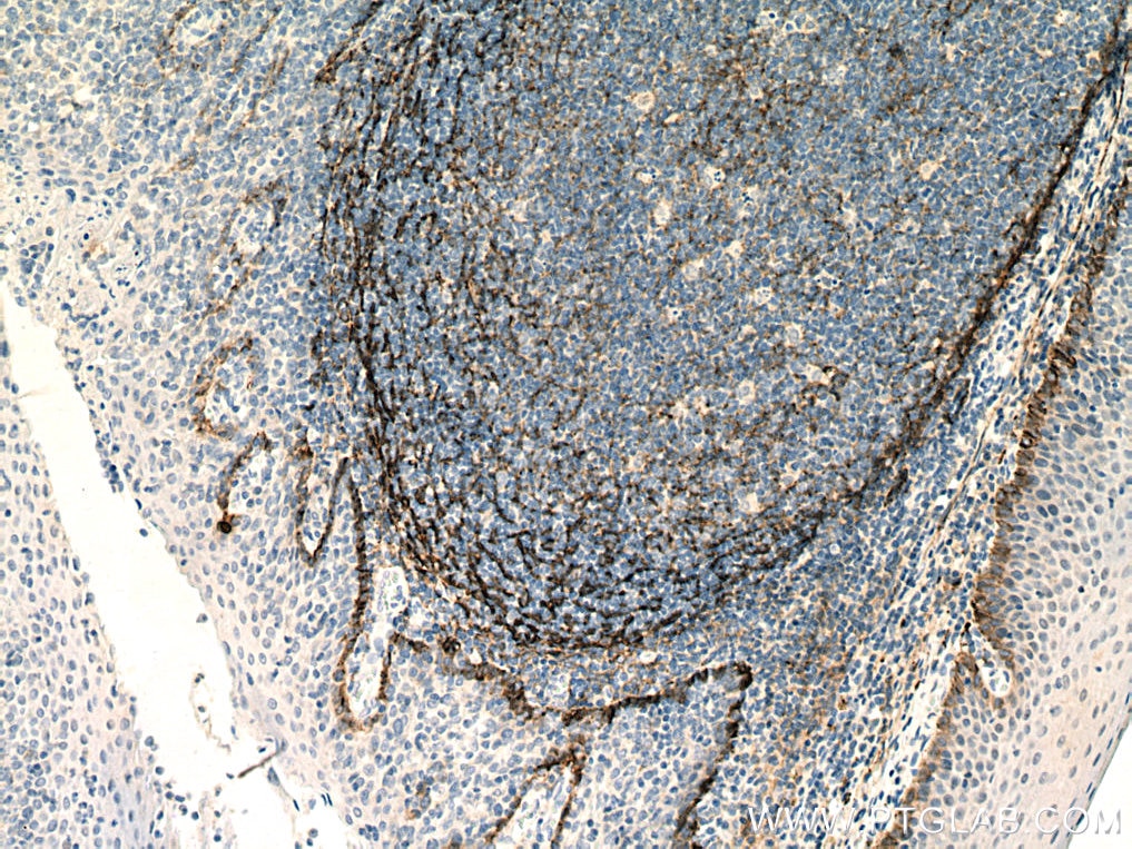 Immunohistochemistry (IHC) staining of human tonsillitis tissue using Podoplanin Monoclonal antibody (67432-1-Ig)