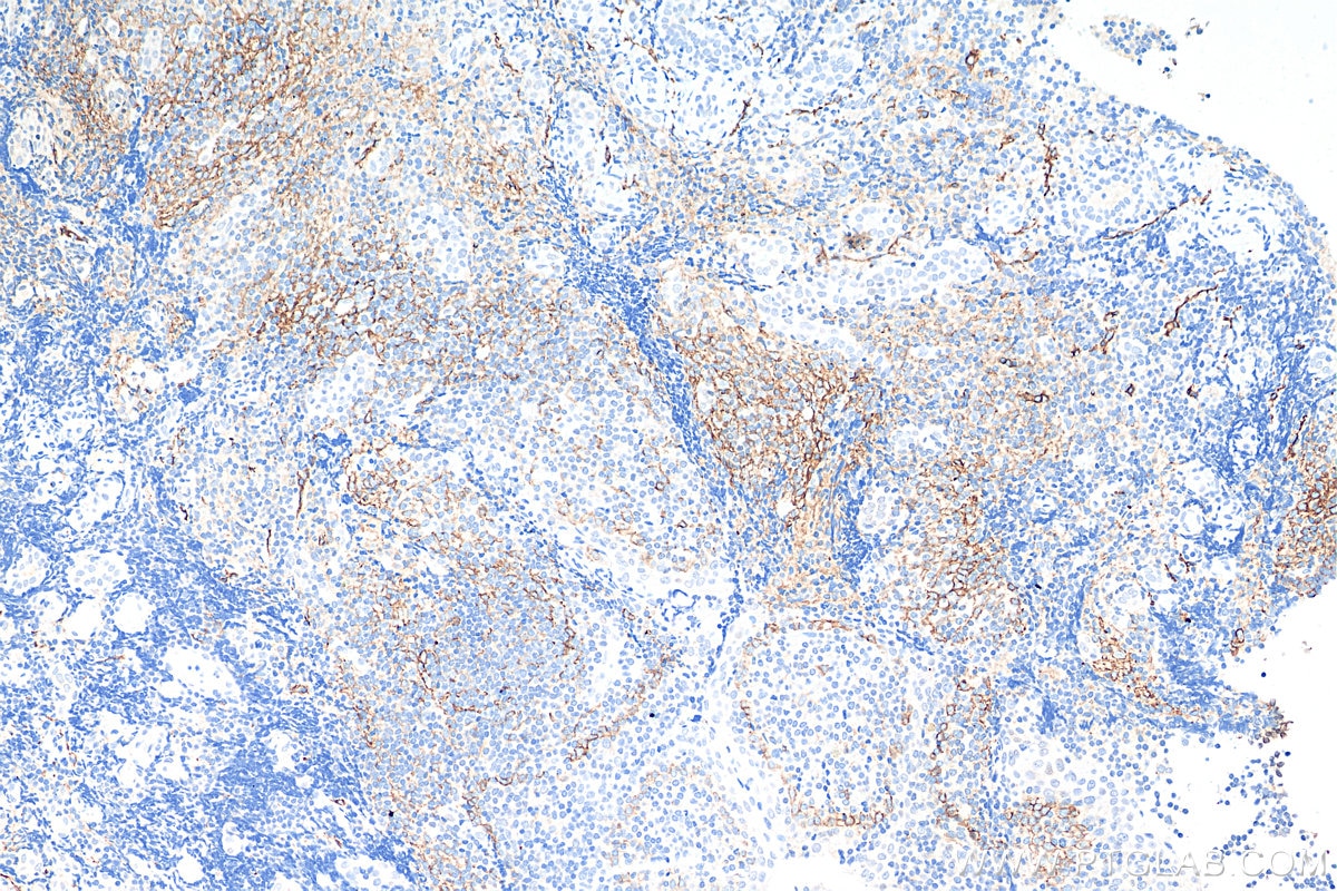 Immunohistochemistry (IHC) staining of human tonsillitis tissue using Podoplanin Monoclonal antibody (67432-1-Ig)