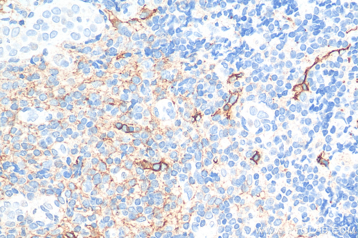 Immunohistochemistry (IHC) staining of human tonsillitis tissue using Podoplanin Monoclonal antibody (67432-1-Ig)