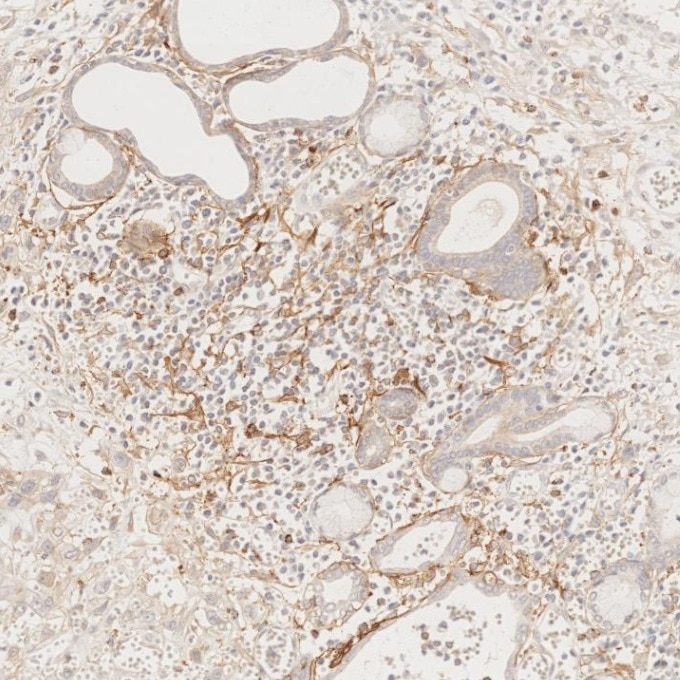 IHC staining of human oesophagus cancer using 67432-1-Ig Immunohistochemistry (IHC) staining of human oesophagus cancer tissue using Podoplanin Monoclonal antibody (67432-1-Ig)