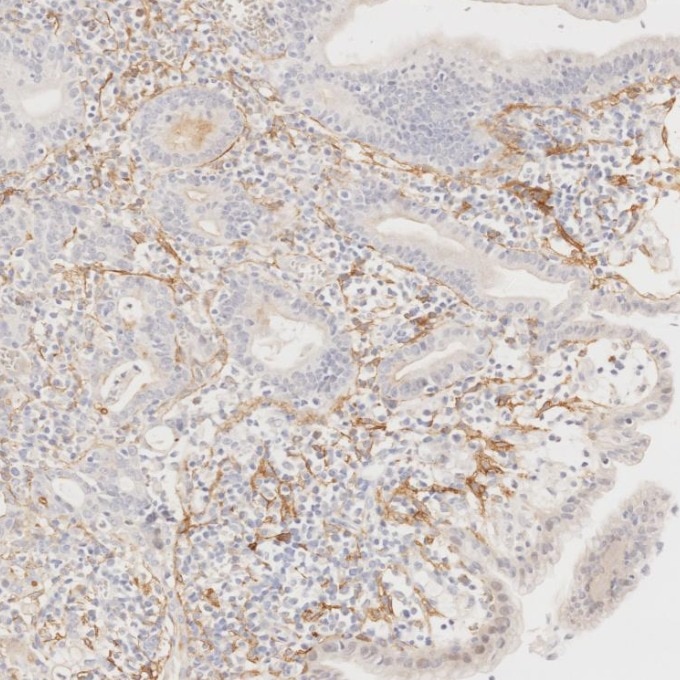 IHC staining of human stomach cancer using 67432-1-Ig Immunohistochemistry (IHC) staining of human stomach cancer tissue using Podoplanin Monoclonal antibody (67432-1-Ig)
