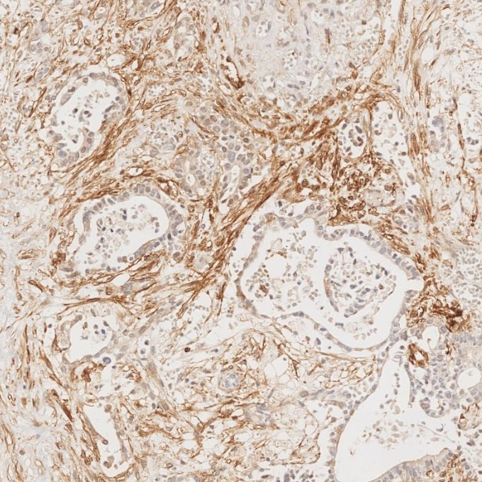 IHC staining of human pancreas cancer using 67432-1-Ig Immunohistochemistry (IHC) staining of human pancreas cancer tissue using Podoplanin Monoclonal antibody (67432-1-Ig)