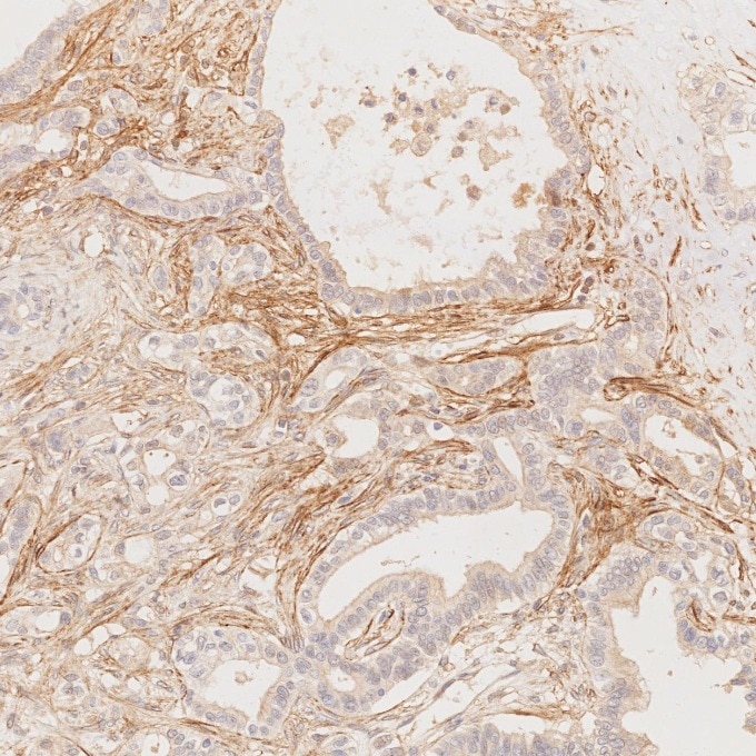 IHC staining of human pancreas cancer using 67432-1-Ig Immunohistochemistry (IHC) staining of human pancreas cancer tissue using Podoplanin Monoclonal antibody (67432-1-Ig)
