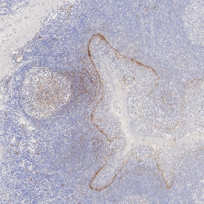 IHC staining of human tonsillitis using 67432-1-Ig Immunohistochemistry (IHC) staining of human tonsillitis tissue using Podoplanin Monoclonal antibody (67432-1-Ig)