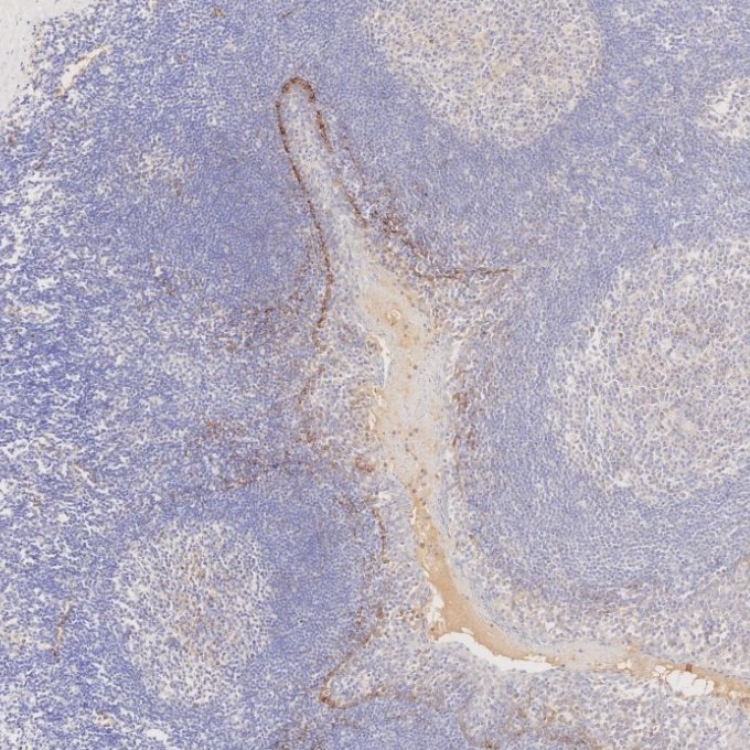 IHC staining of human tonsillitis using 67432-1-Ig Immunohistochemistry (IHC) staining of human tonsillitis tissue using Podoplanin Monoclonal antibody (67432-1-Ig)
