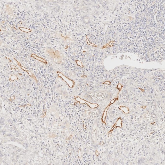 IHC staining of human liver using 67432-1-Ig Immunohistochemistry (IHC) staining of human liver tissue using Podoplanin Monoclonal antibody (67432-1-Ig)
