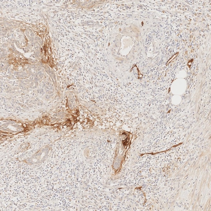 IHC staining of human pancreas using 67432-1-Ig Immunohistochemistry (IHC) staining of human pancreas tissue using Podoplanin Monoclonal antibody (67432-1-Ig)