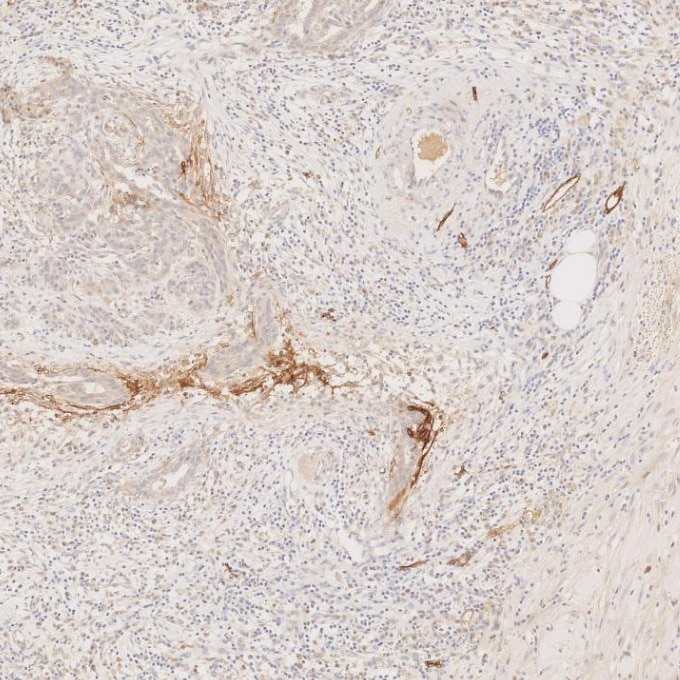IHC staining of human pancreas using 67432-1-Ig Immunohistochemistry (IHC) staining of human pancreas tissue using Podoplanin Monoclonal antibody (67432-1-Ig)
