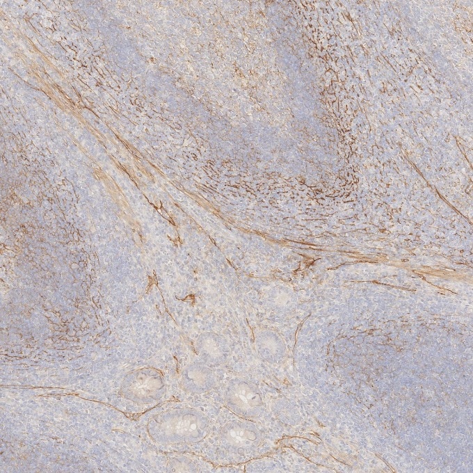IHC staining of human appendicitis using 67432-1-Ig Immunohistochemistry (IHC) staining of human appendicitis tissue using Podoplanin Monoclonal antibody (67432-1-Ig)