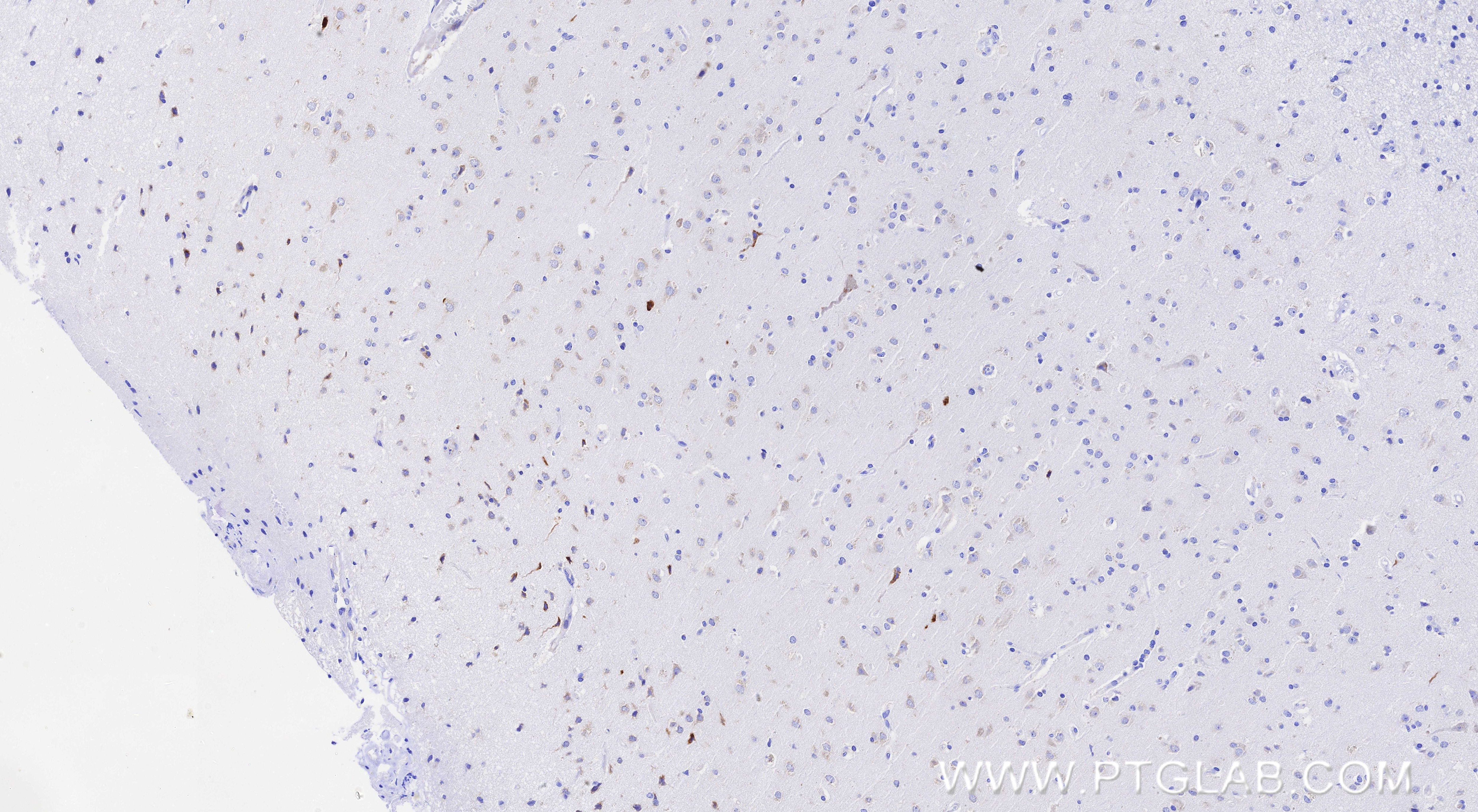 Immunohistochemistry (IHC) staining of Human brain cancer（Astrocitoma） using Presenilin-1-Specific Recombinant monoclonal antib (83618-5-RR)