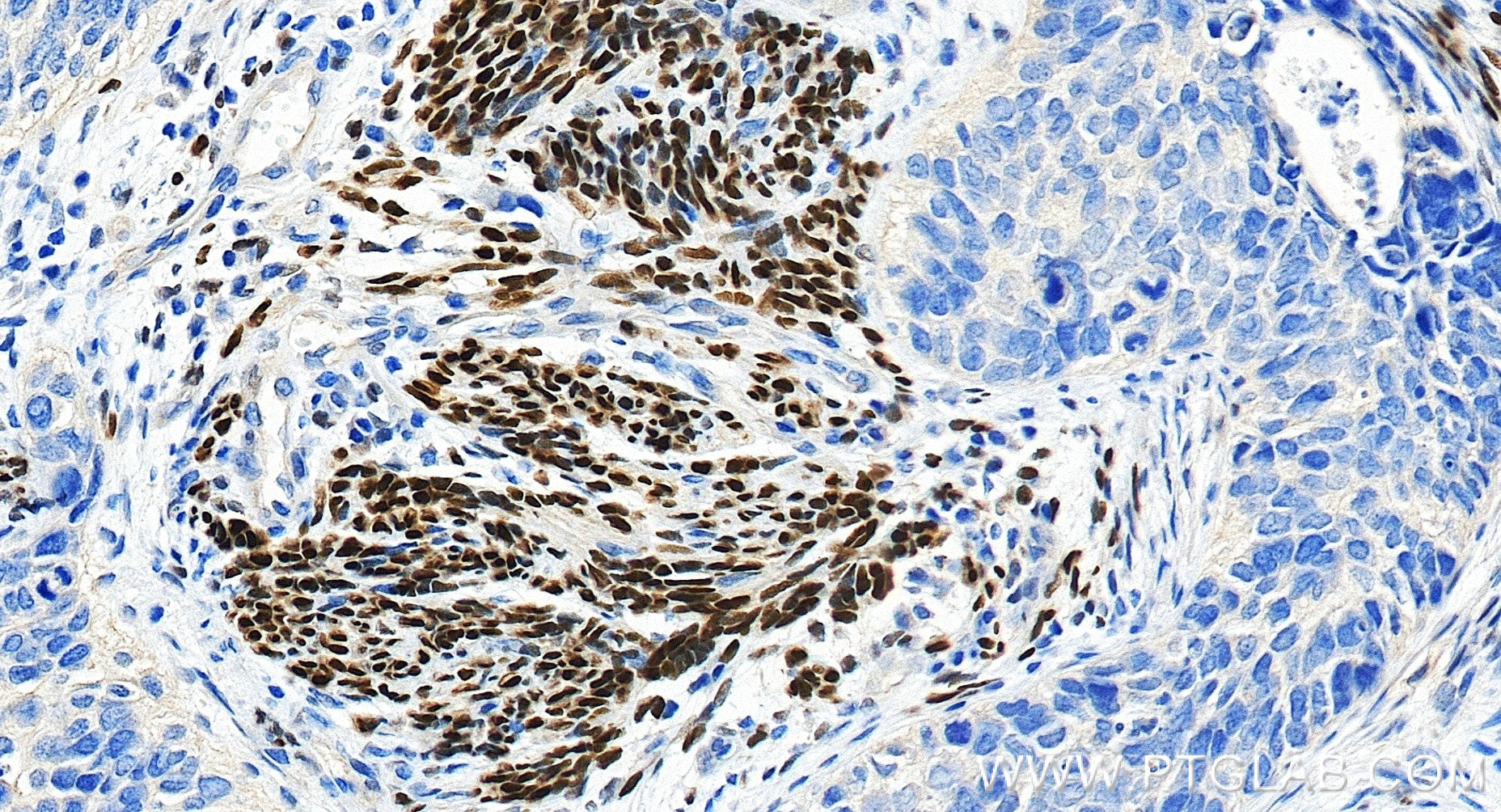 IHC staining of human cervical cancer using 85112-4-RR Immunohistochemistry (IHC) staining of human cervical cancer tissue using Progesterone Receptor Recombinant monoclonal antib (85112-4-RR)