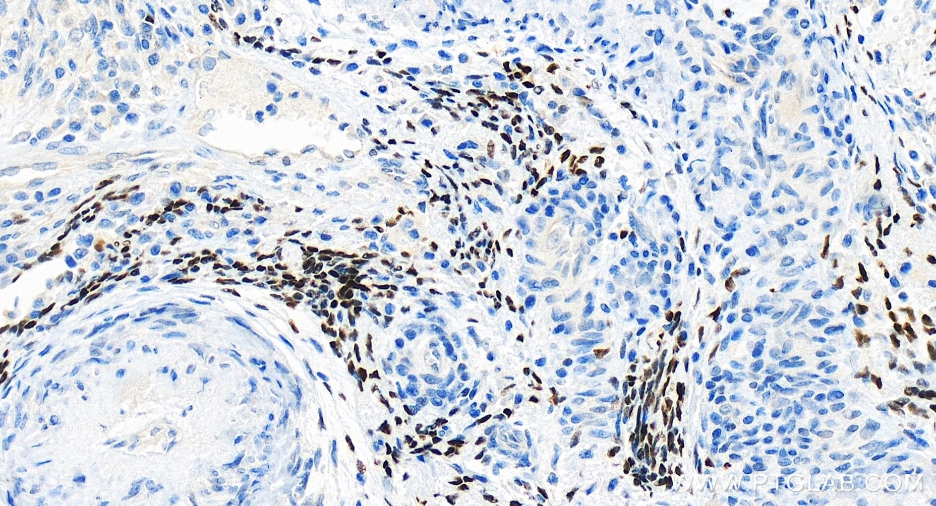 Immunohistochemistry (IHC) staining of human cervical cancer tissue using Progesterone Receptor Recombinant antibody (85112-4-RR)