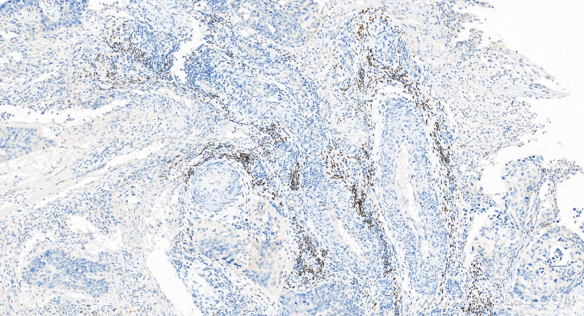 Immunohistochemistry (IHC) staining of human cervical cancer tissue using Progesterone Receptor Recombinant antibody (85112-4-RR)