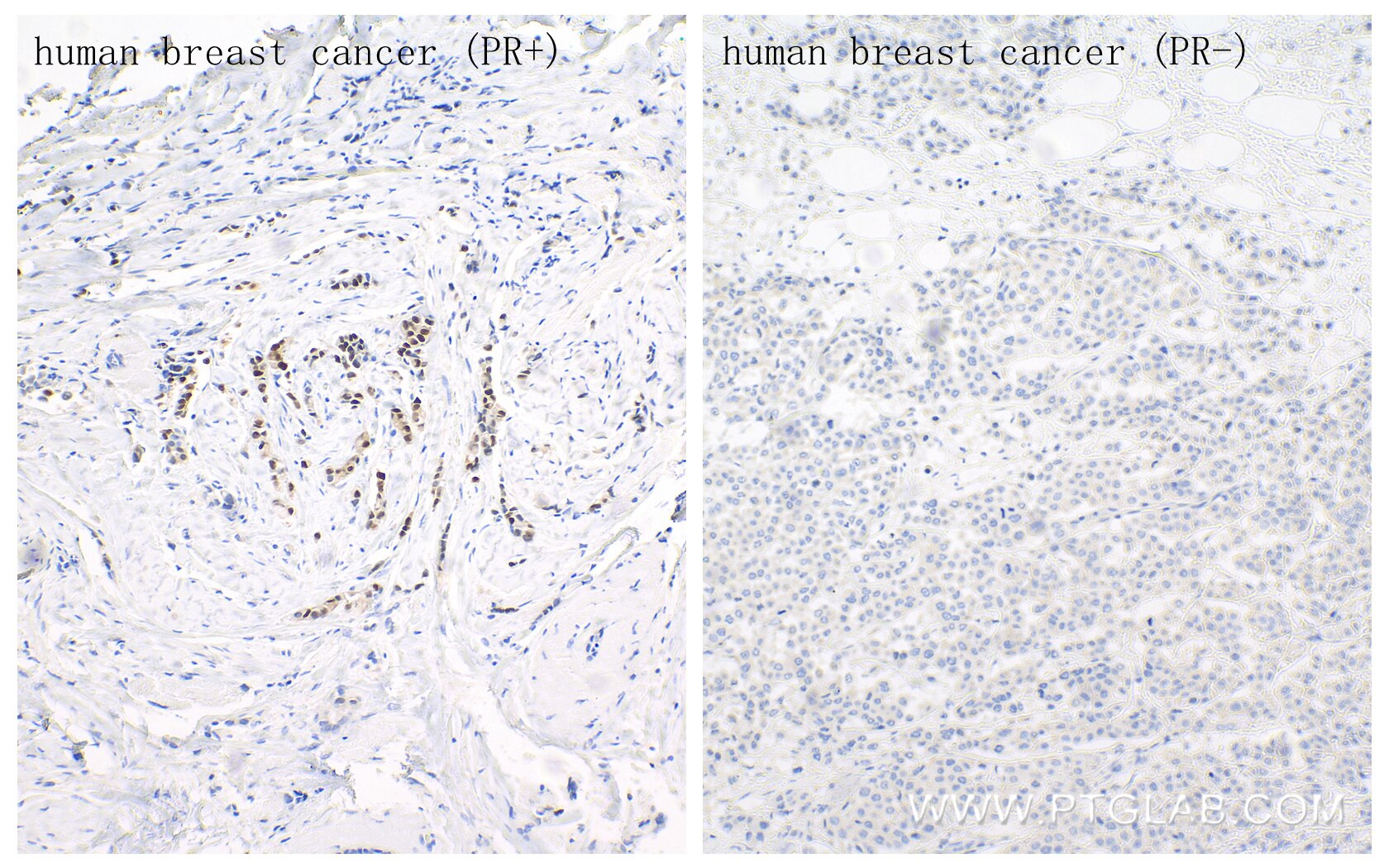 Immunohistochemistry (IHC) staining of human breast cancer tissue using Progesterone Receptor Recombinant antibody (85112-4-RR)