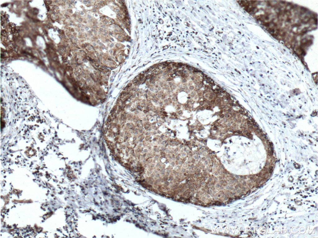 Immunohistochemistry (IHC) staining of human breast cancer tissue using Prohibitin 2 Monoclonal antibody (66424-1-Ig)