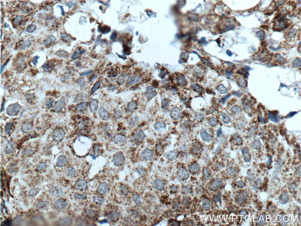 Immunohistochemistry (IHC) staining of human breast cancer tissue using Prohibitin 2 Monoclonal antibody (66424-1-Ig)