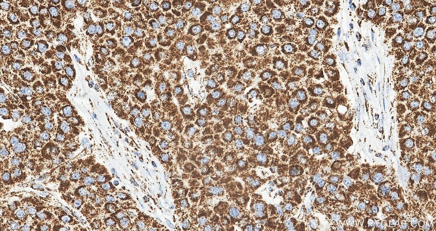 IHC staining of human liver cancer using 88442-1-RR Immunohistochemistry (IHC) staining of human liver cancer tissue using Prohibitin Recombinant monoclonal antibody (88442-1-RR)