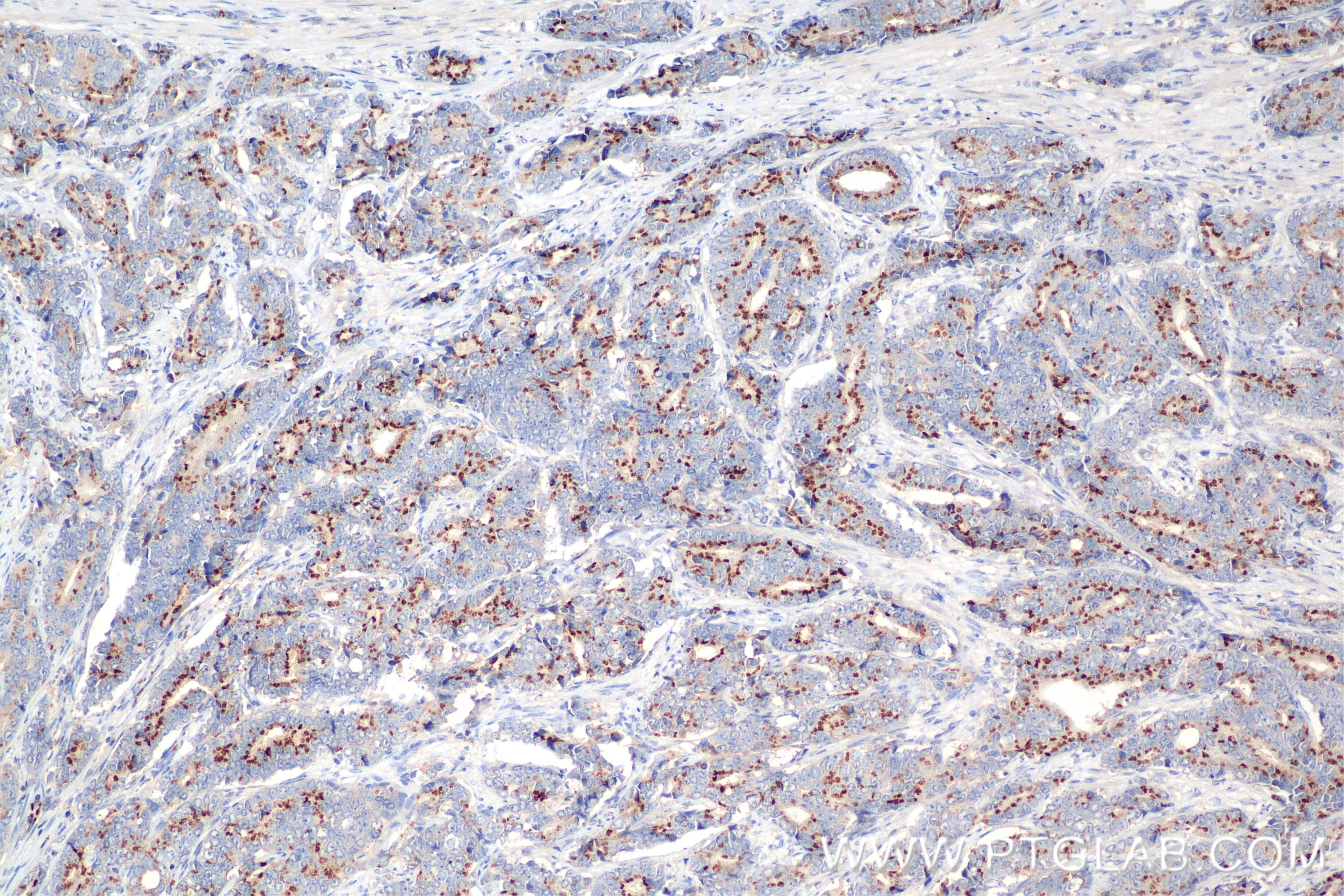 Immunohistochemistry (IHC) staining of human prostate cancer tissue using Prostein Recombinant antibody (84629-2-RR)