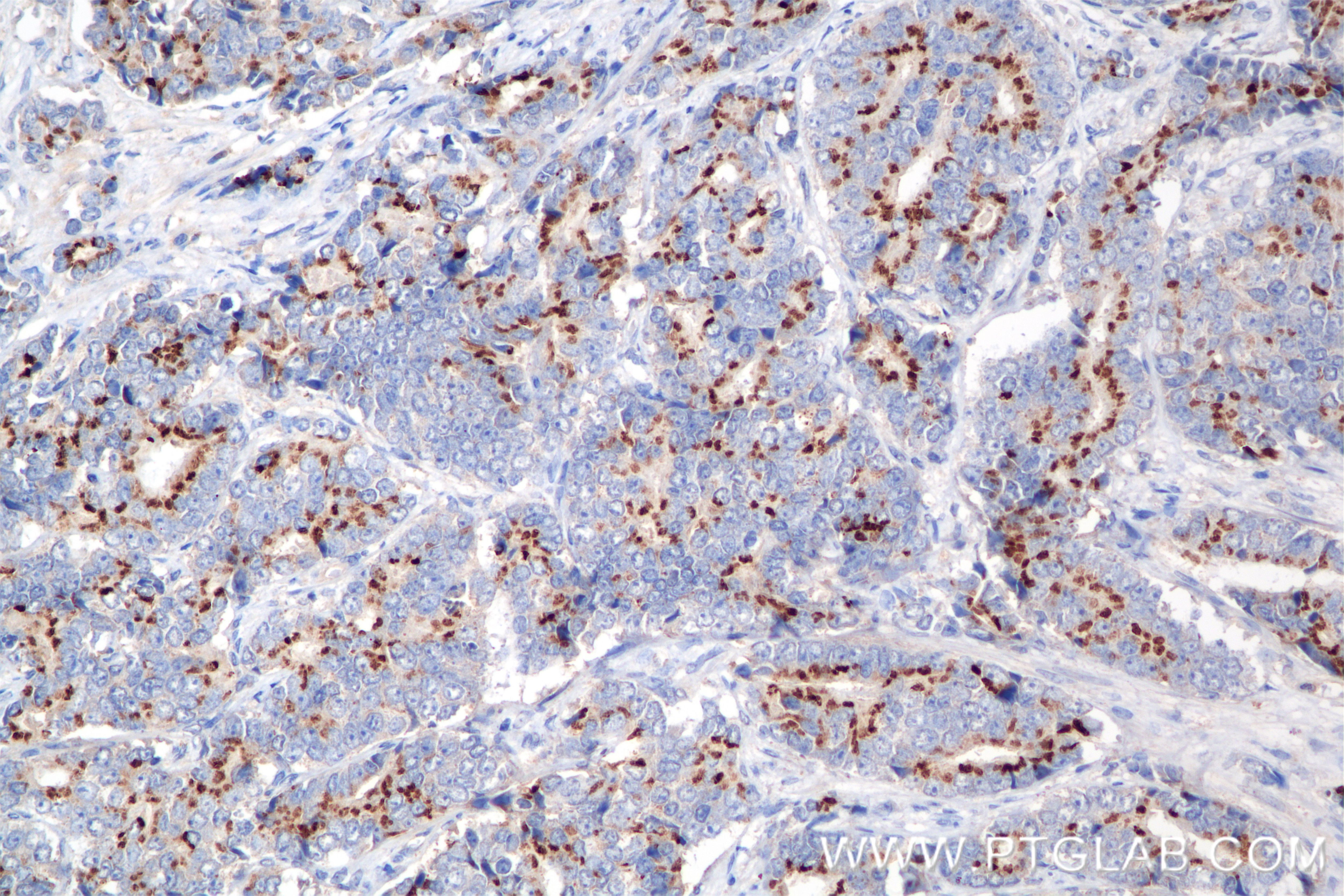 Immunohistochemistry (IHC) staining of human prostate cancer tissue using Prostein Recombinant antibody (84629-2-RR)