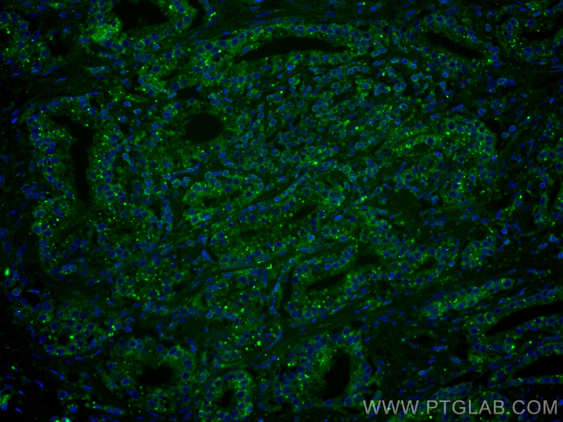 Immunofluorescence (IF) / fluorescent staining of human prostate cancer tissue using CoraLite® Plus 488-conjugated Prostein Monoclonal  (CL488-60343)