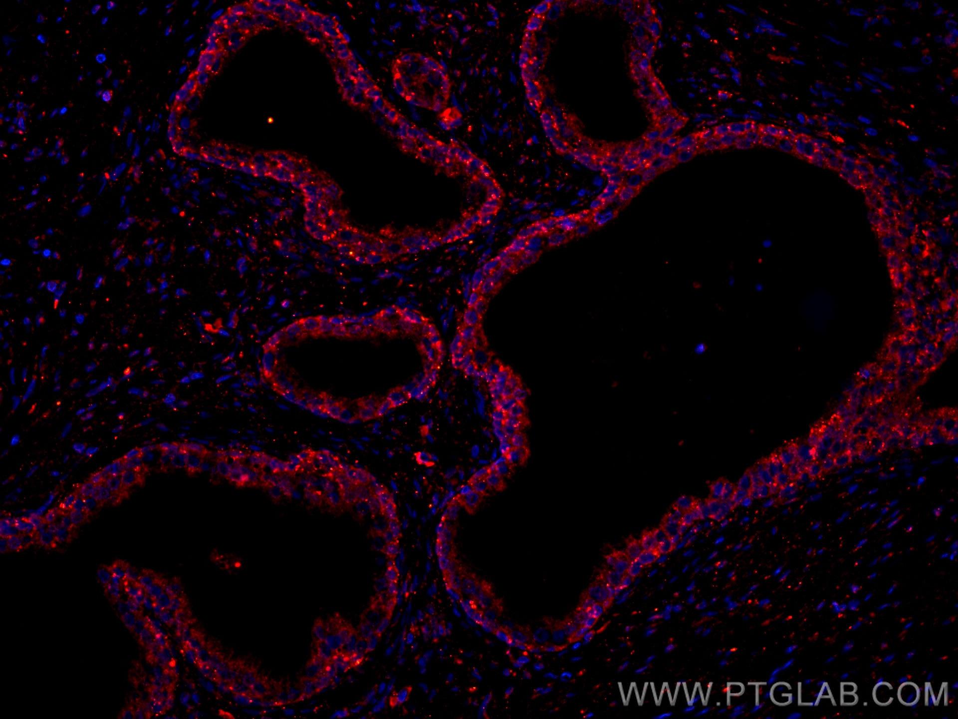 Immunofluorescence (IF) / fluorescent staining of human prostate cancer tissue using CoraLite®594-conjugated Prostein Monoclonal antibo (CL594-60343)