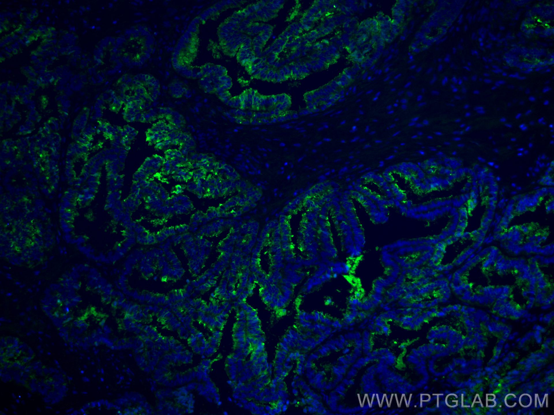 Immunofluorescence (IF) / fluorescent staining of human ovary tumor tissue using CoraLite® Plus 488-conjugated Protein C inhibitor  (CL488-66030)