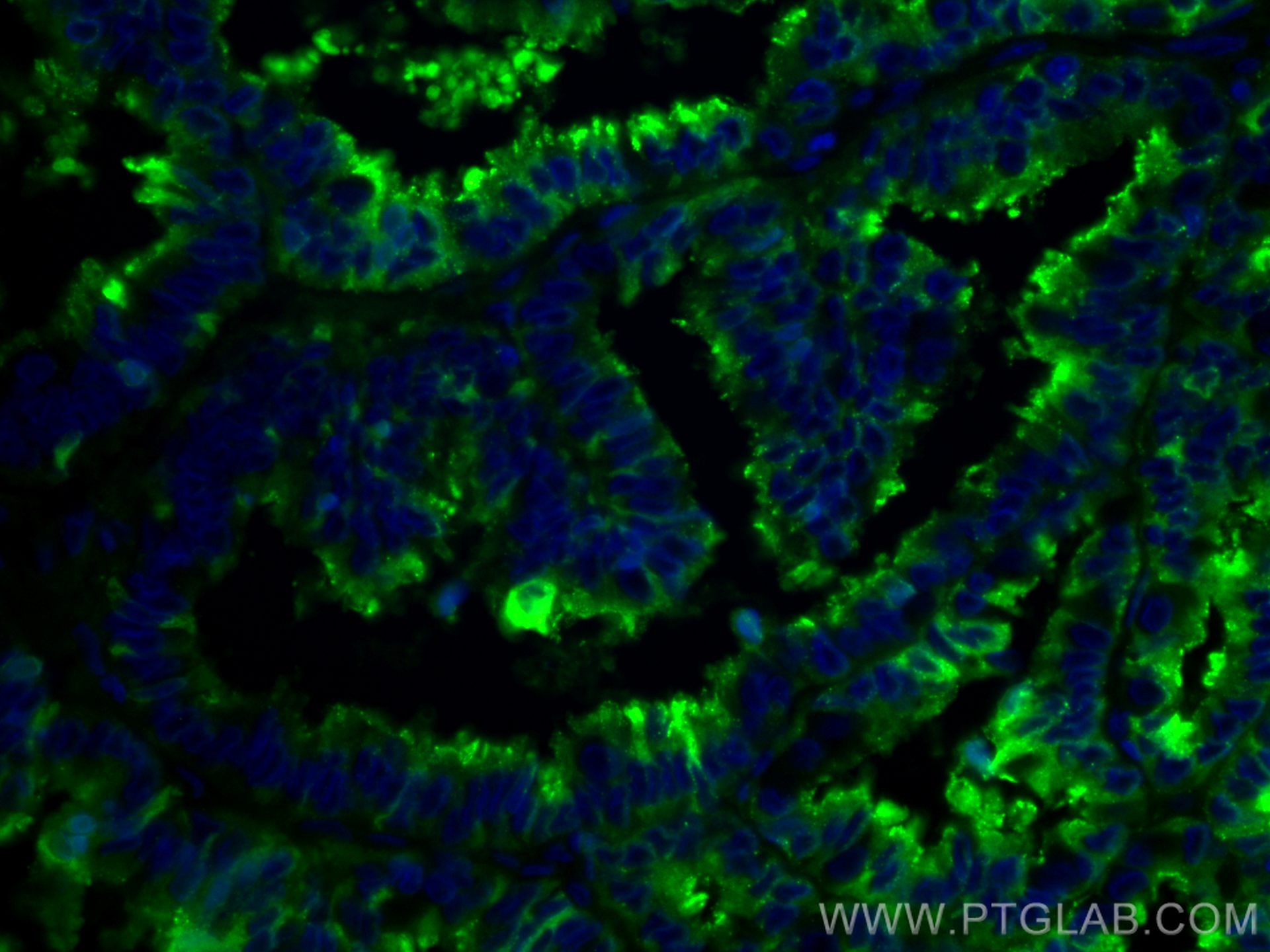 Immunofluorescence (IF) / fluorescent staining of human ovary tumor tissue using CoraLite® Plus 488-conjugated Protein C inhibitor  (CL488-66030)