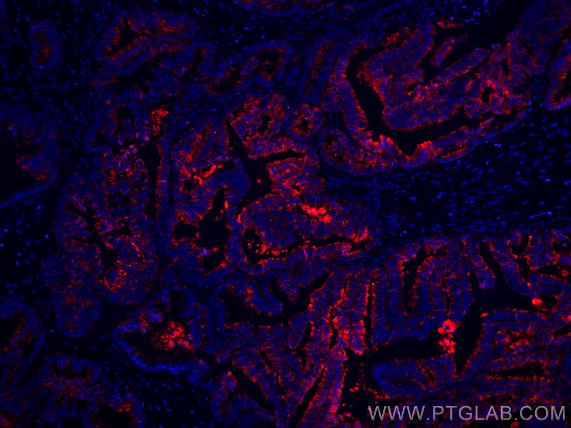 Immunofluorescence (IF) / fluorescent staining of human ovary tumor tissue using CoraLite®594-conjugated Protein C inhibitor Monocl (CL594-66030)