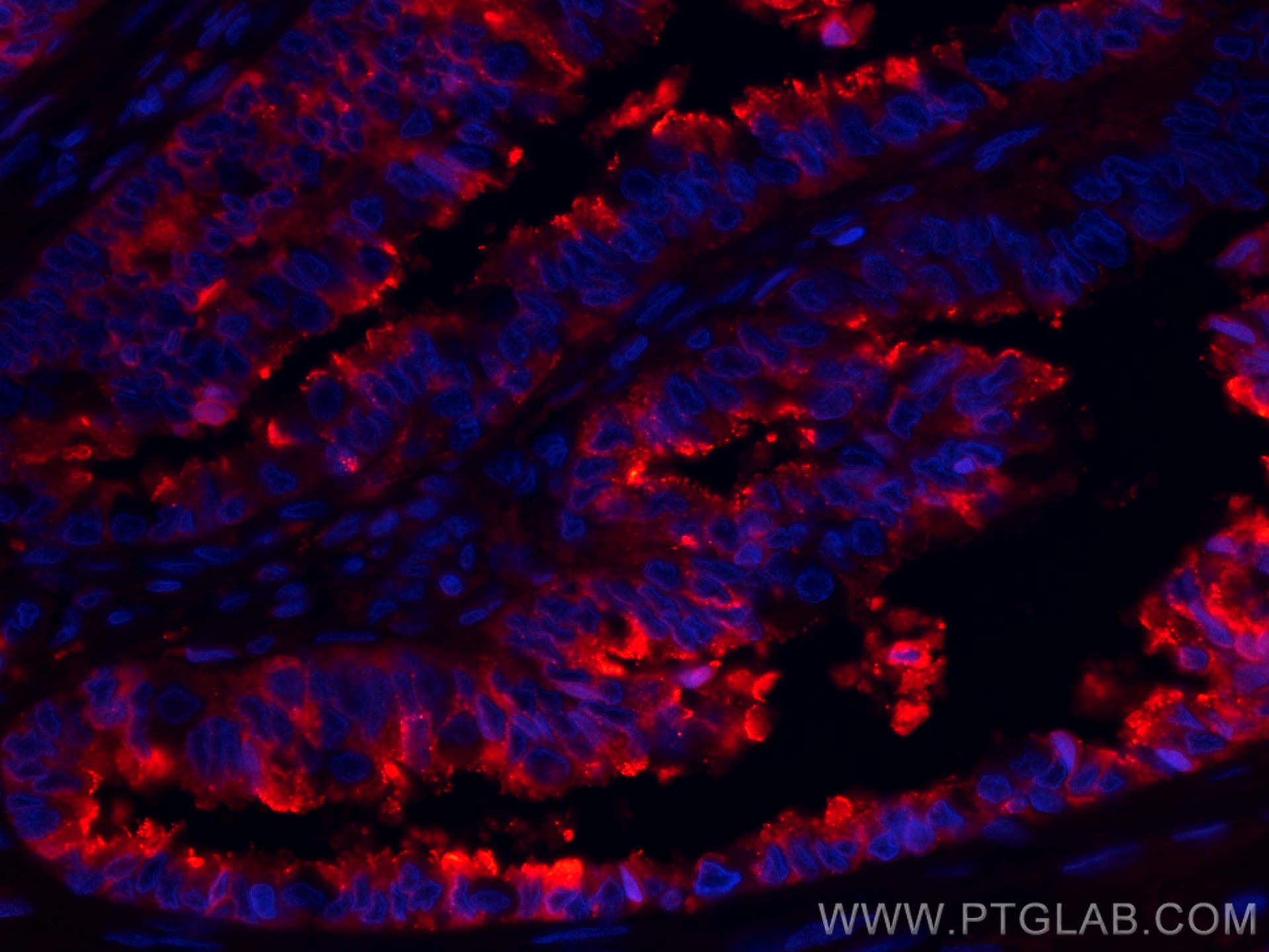 Immunofluorescence (IF) / fluorescent staining of human ovary tumor tissue using CoraLite®594-conjugated Protein C inhibitor Monocl (CL594-66030)