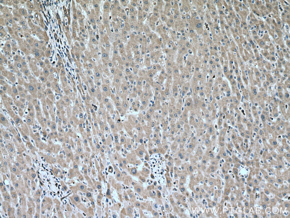 Immunohistochemistry (IHC) staining of human liver cancer tissue using PRX5 Monoclonal antibody (67599-1-Ig)