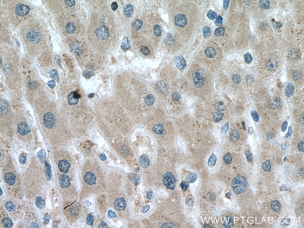 Immunohistochemistry (IHC) staining of human liver cancer tissue using PRX5 Monoclonal antibody (67599-1-Ig)