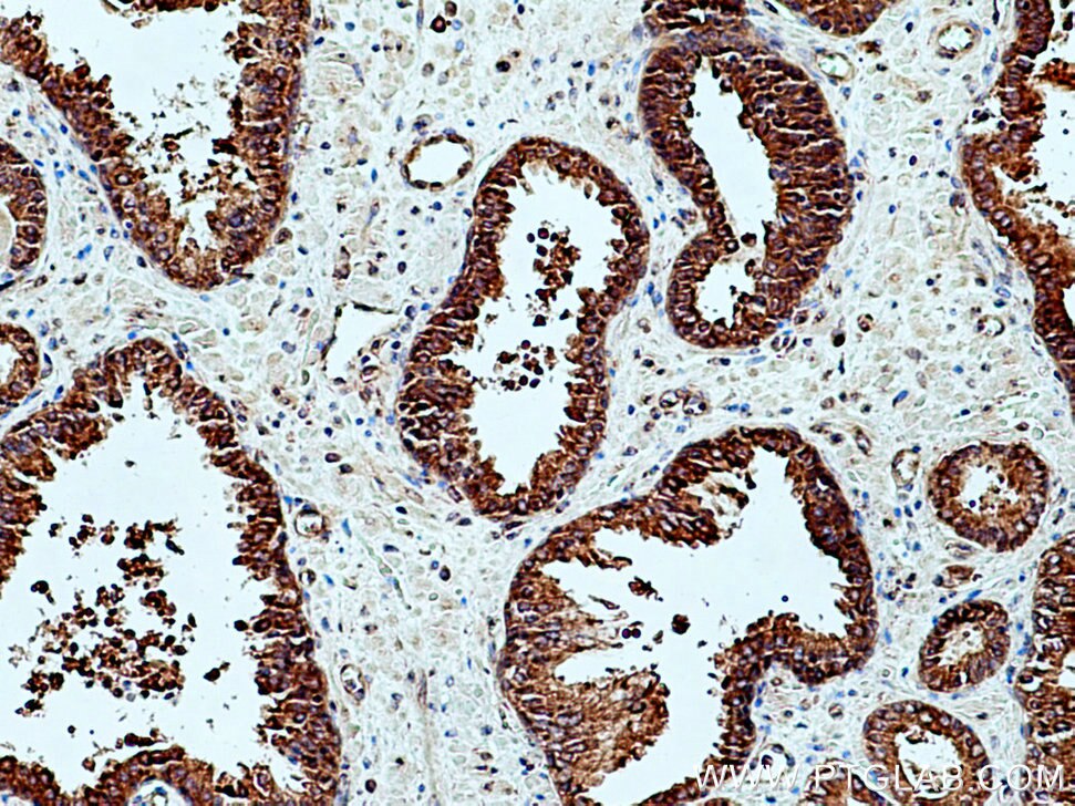 Immunohistochemistry (IHC) staining of human prostate cancer tissue using GlnRS Polyclonal antibody (12645-1-AP)