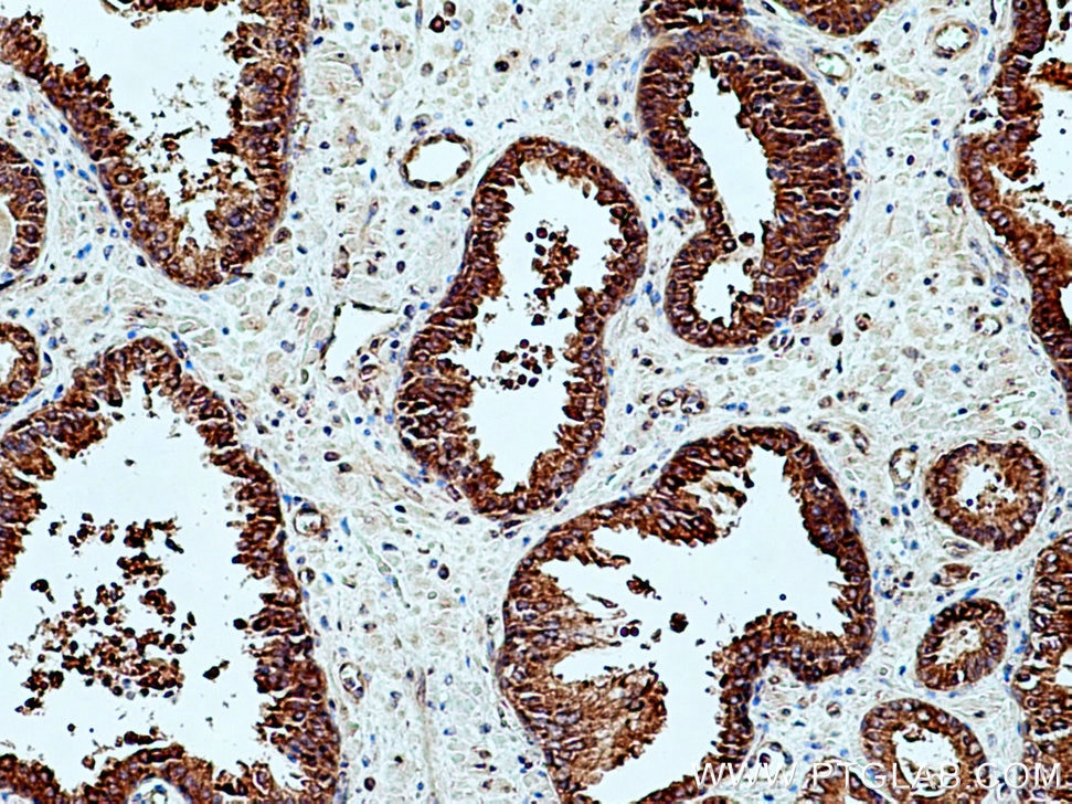 IHC staining of human prostate cancer using 12645-1-AP