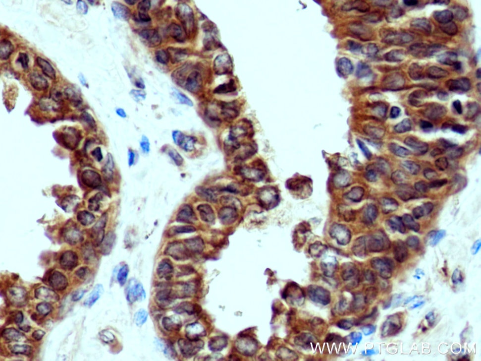 Immunohistochemistry (IHC) staining of human prostate cancer tissue using GlnRS Polyclonal antibody (12645-1-AP)