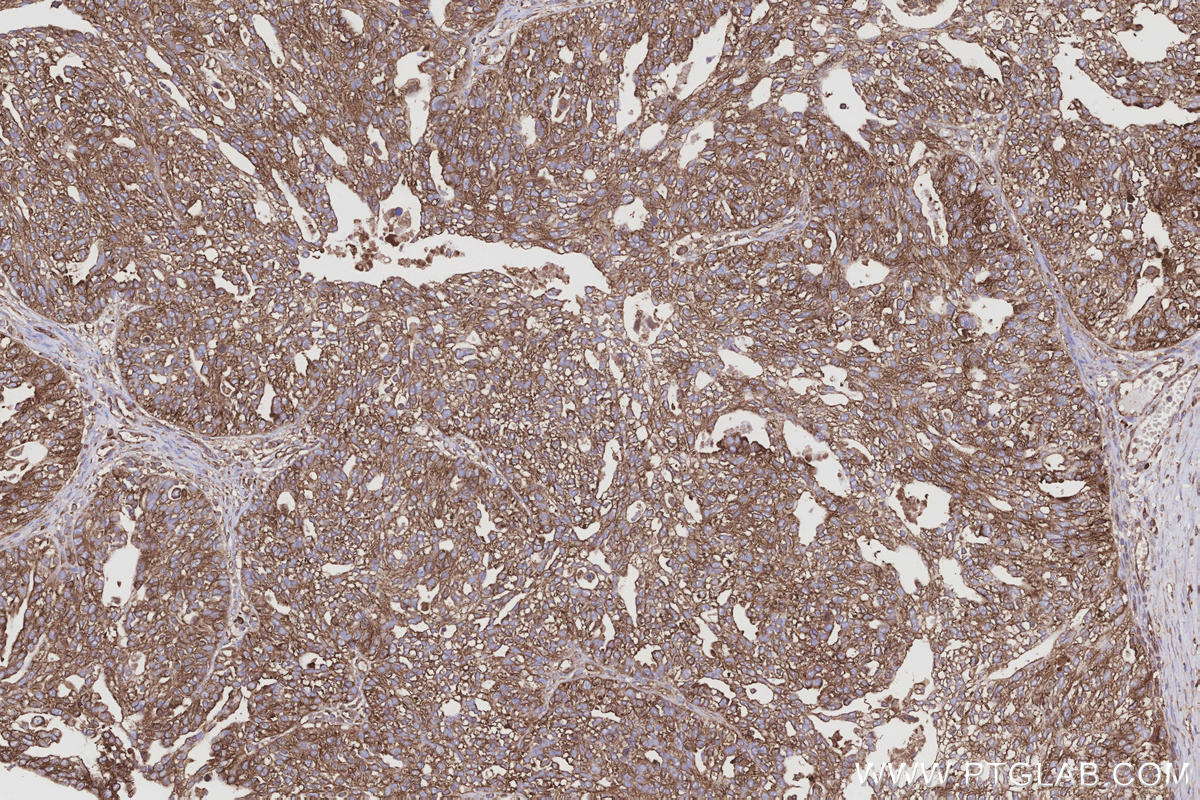 Immunohistochemistry (IHC) staining of human ovary cancer tissue using GlnRS Polyclonal antibody (12645-1-AP)