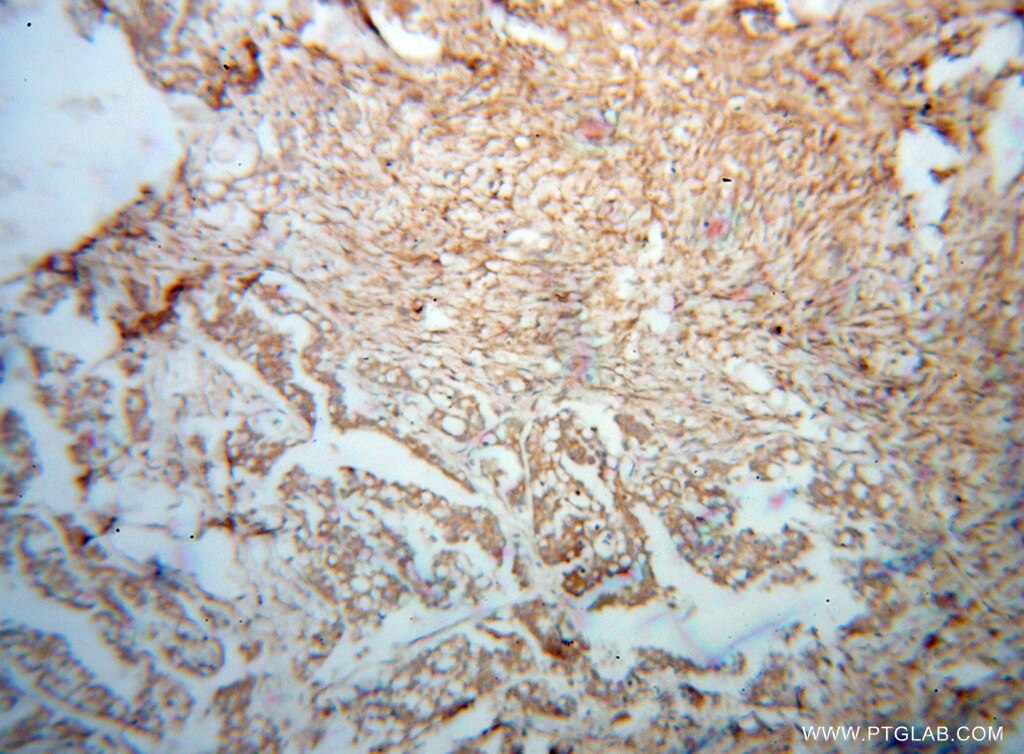 Immunohistochemistry (IHC) staining of human ovary tumor tissue using QDPR Polyclonal antibody (14908-1-AP)