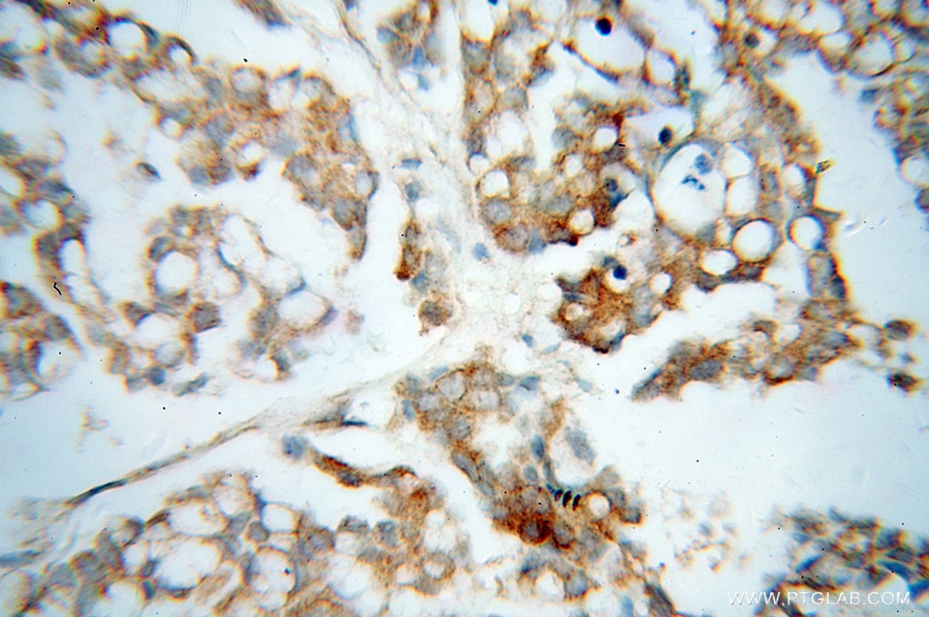 Immunohistochemistry (IHC) staining of human ovary tumor tissue using QDPR Polyclonal antibody (14908-1-AP)
