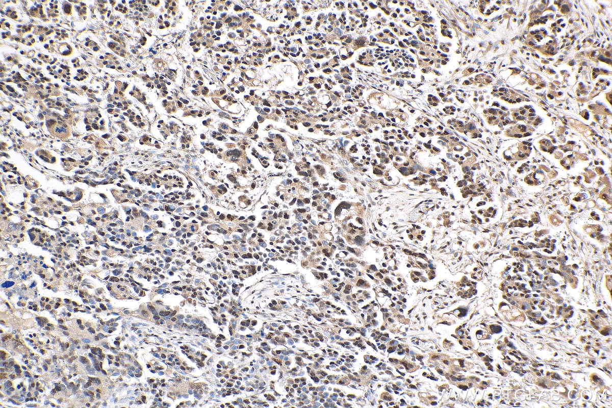 IHC staining of human colon cancer using 30236-1-AP