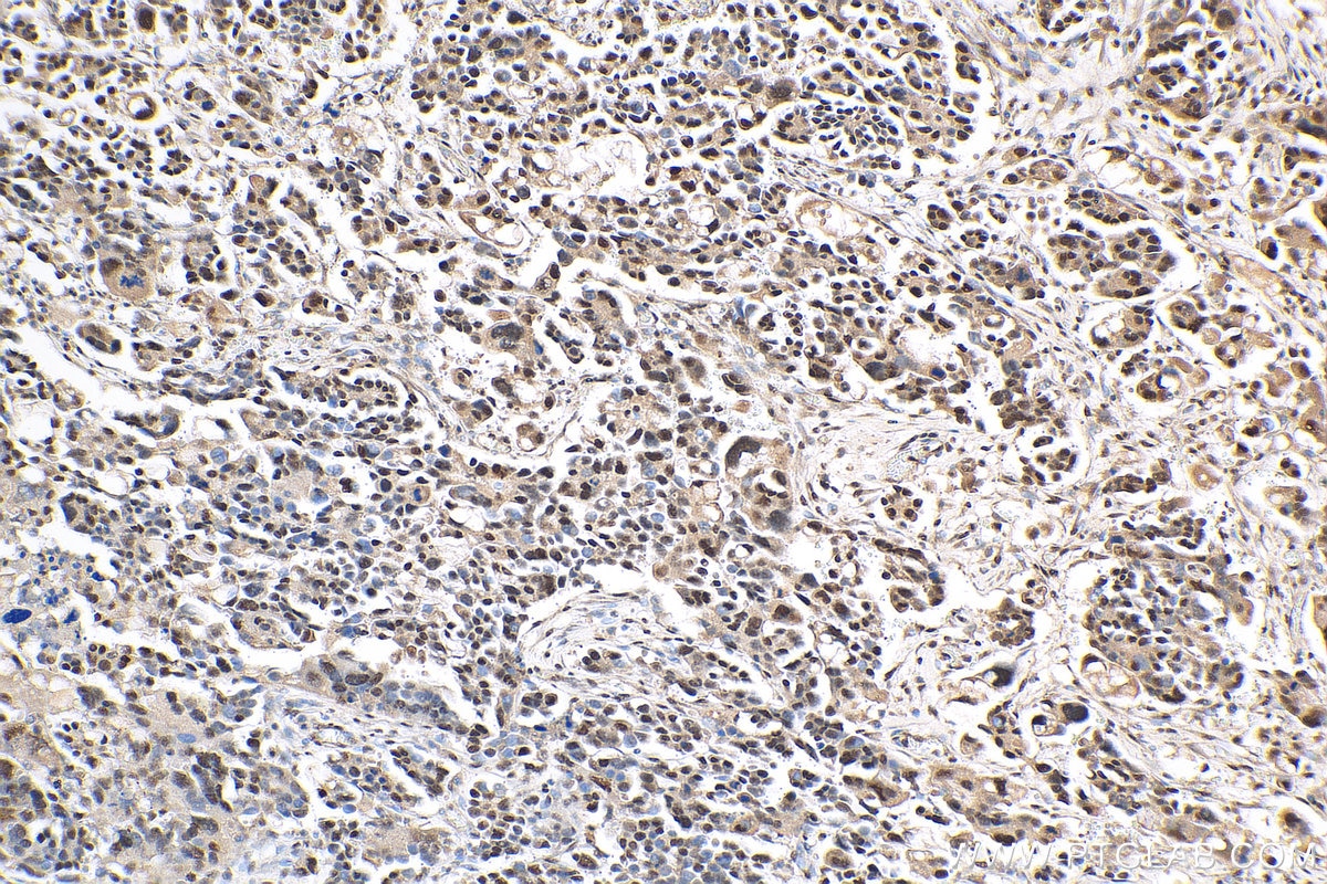 Immunohistochemistry (IHC) staining of human colon cancer tissue using QRICH1 Polyclonal antibody (30236-1-AP)