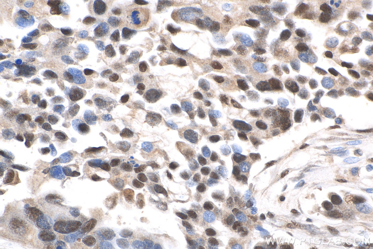 Immunohistochemistry (IHC) staining of human colon cancer tissue using QRICH1 Polyclonal antibody (30236-1-AP)