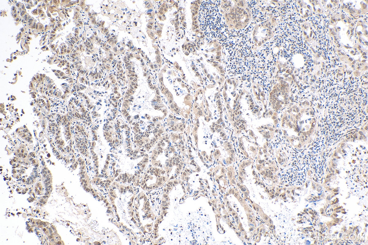 Immunohistochemistry (IHC) staining of human lung cancer tissue using QRICH1 Polyclonal antibody (30236-1-AP)