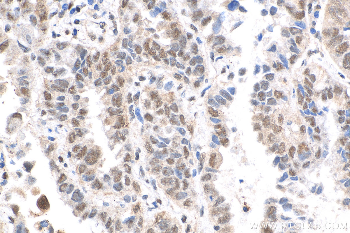Immunohistochemistry (IHC) staining of human lung cancer tissue using QRICH1 Polyclonal antibody (30236-1-AP)