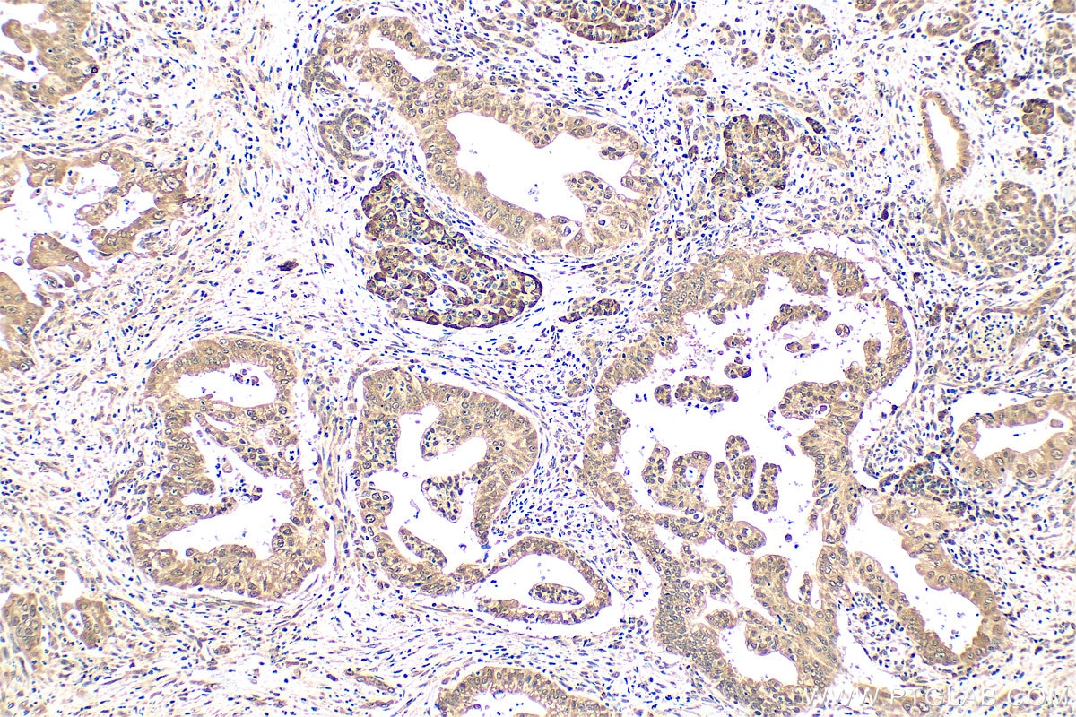 IHC staining of human pancreas cancer using 55326-1-AP (same clone as 55326-1-PBS) Immunohistochemistry (IHC) staining of human pancreas cancer tissue using QSER1 Polyclonal antibody (55326-1-AP)